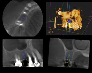 歯科用CTの活用
