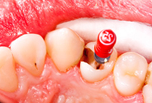 保険による歯内治療（根管治療）