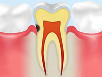 根面う蝕