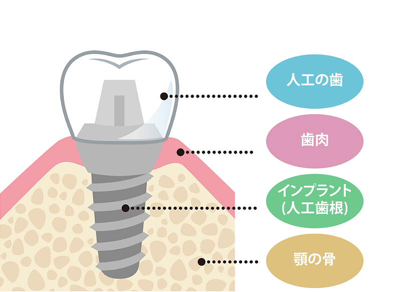 インプラントの構造