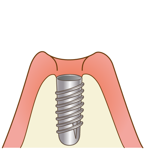 インプラント治療の流れ １回法