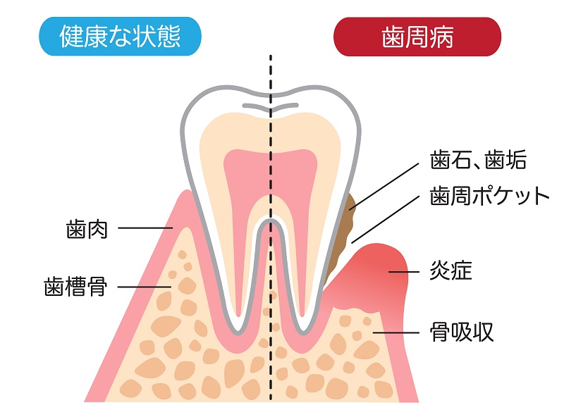 虫歯になりやすくなる