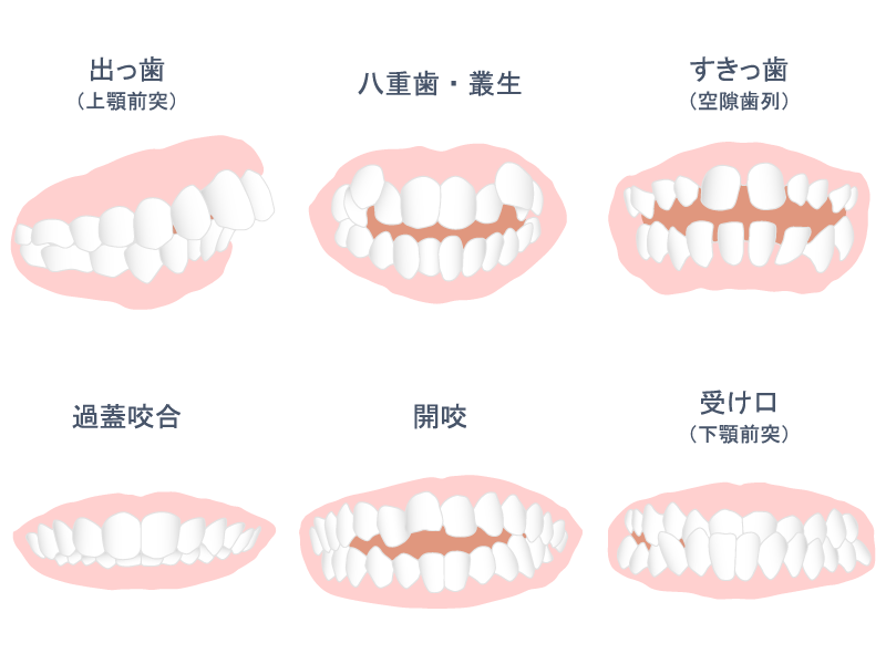 保険による歯内治療（根管治療）