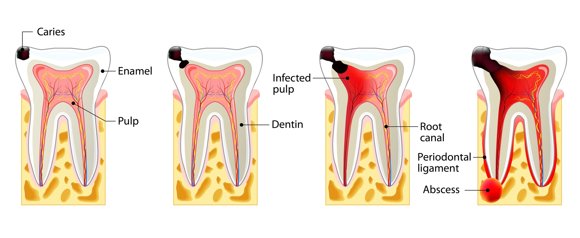 歯内治療（根管治療）について