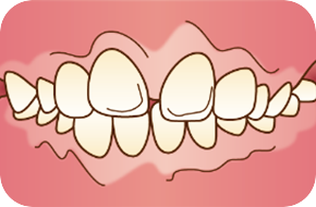 上顎前突(出っ歯)