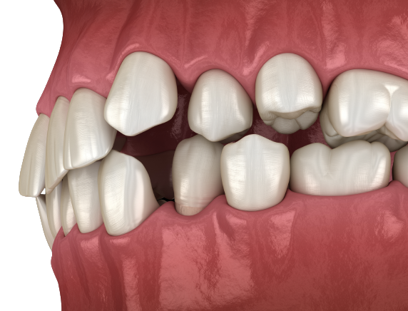 精密な歯内治療（マイクロ根管治療）～自費診療～