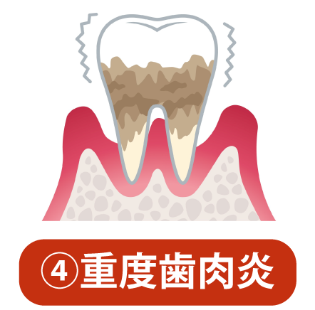 歯周病について