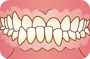 下顎前突(反対咬合・受け口)