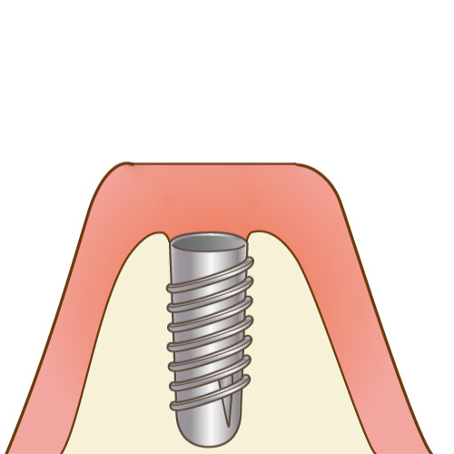 インプラント治療の流れ ２回法
