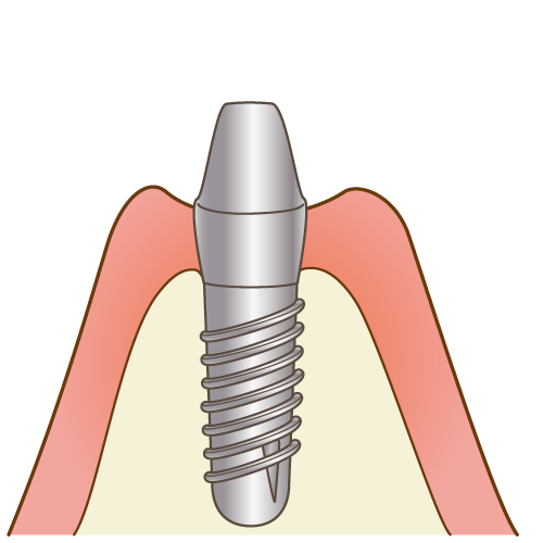 インプラント治療の流れ １回法