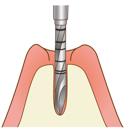 インプラント治療の流れ １回法
